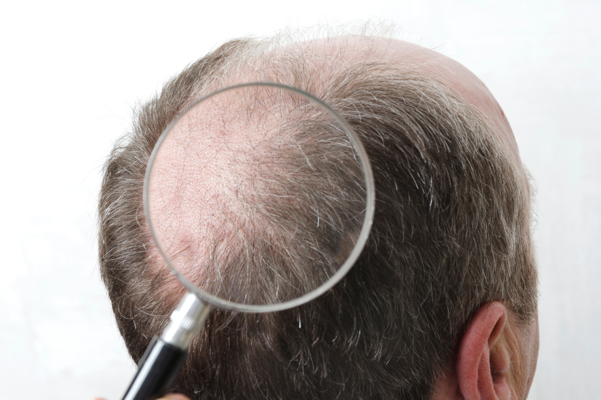 Przeszczep włosów – ratunek dla osób zmagających się z łysieniem!